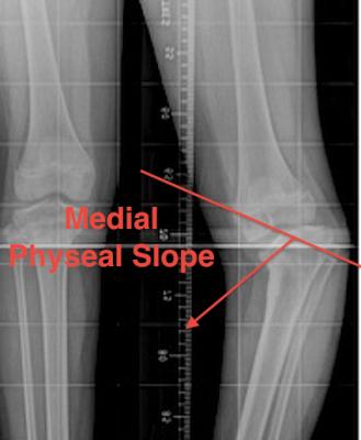 Blounts Medial Physeal Angle
