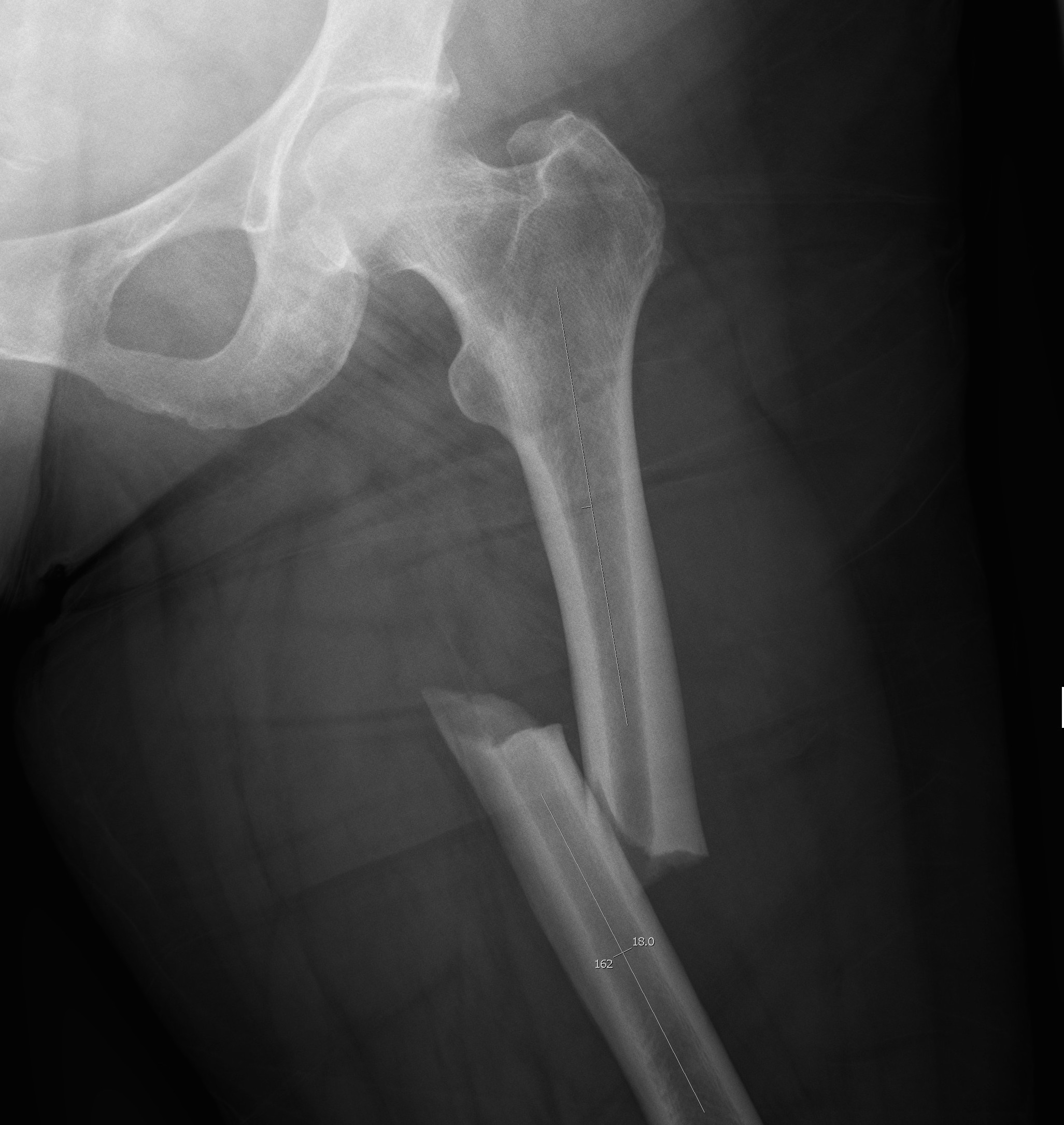 Femoral Shaft Fractures The Bone School