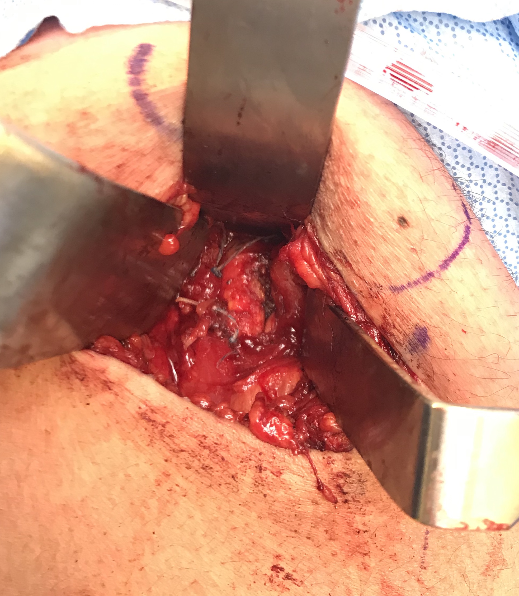 Post suture repair