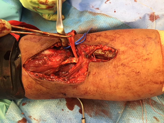 Biceps reconstruction with tendoachilles allograft