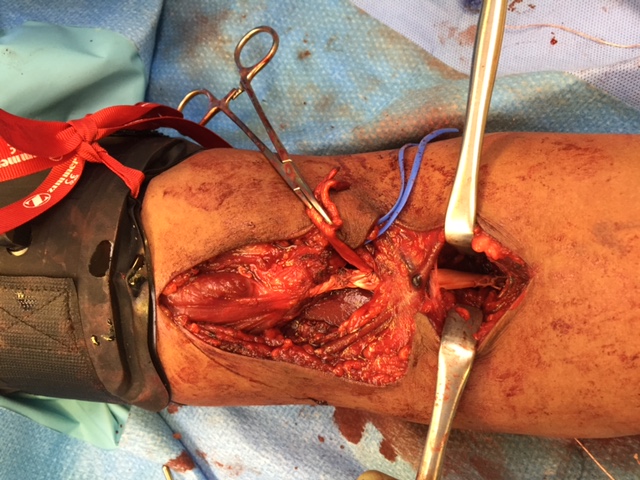 Distal biceps reconstruction with allograft
