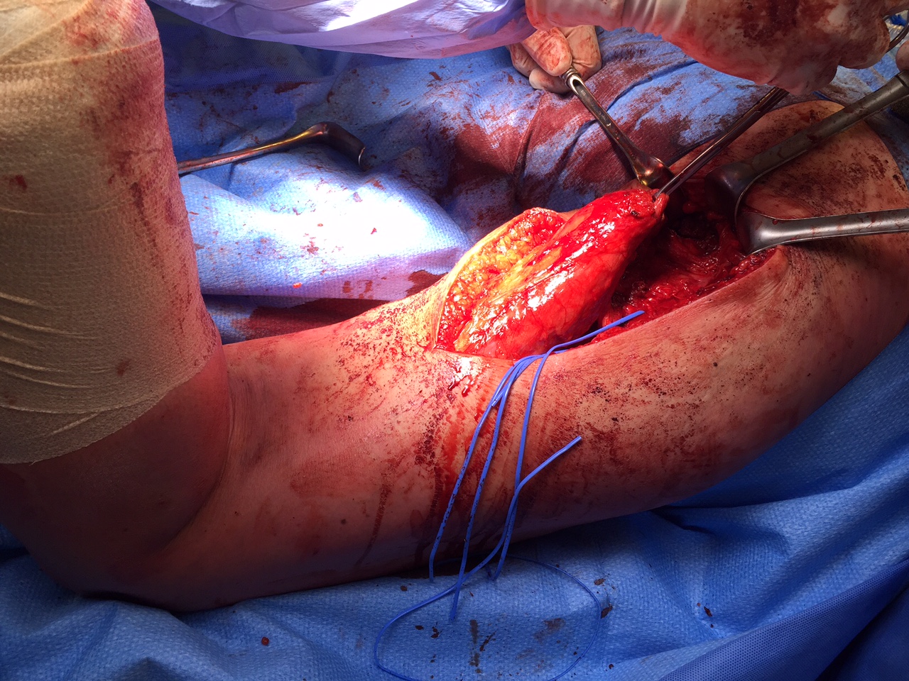 Acl injury complications