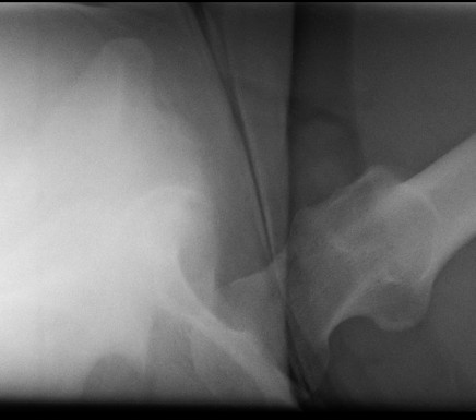 Posterior Hip Dislocation Lateral