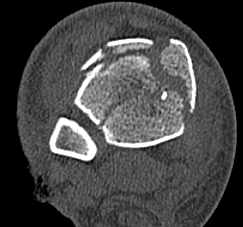 Severe Tibial Plafond CT Axial