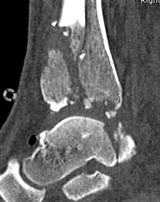 Severe Tibial Plafond CT Sagittal