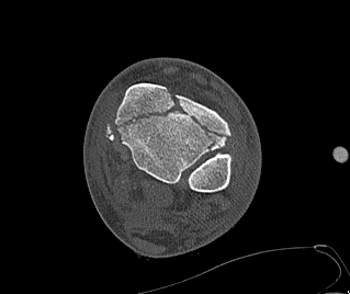 Tibial Plafond CT Axial