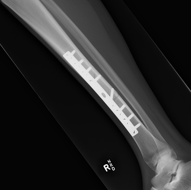 Tibial Midshaft Plate Lateral