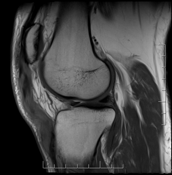 Chronic patella tendon rupture