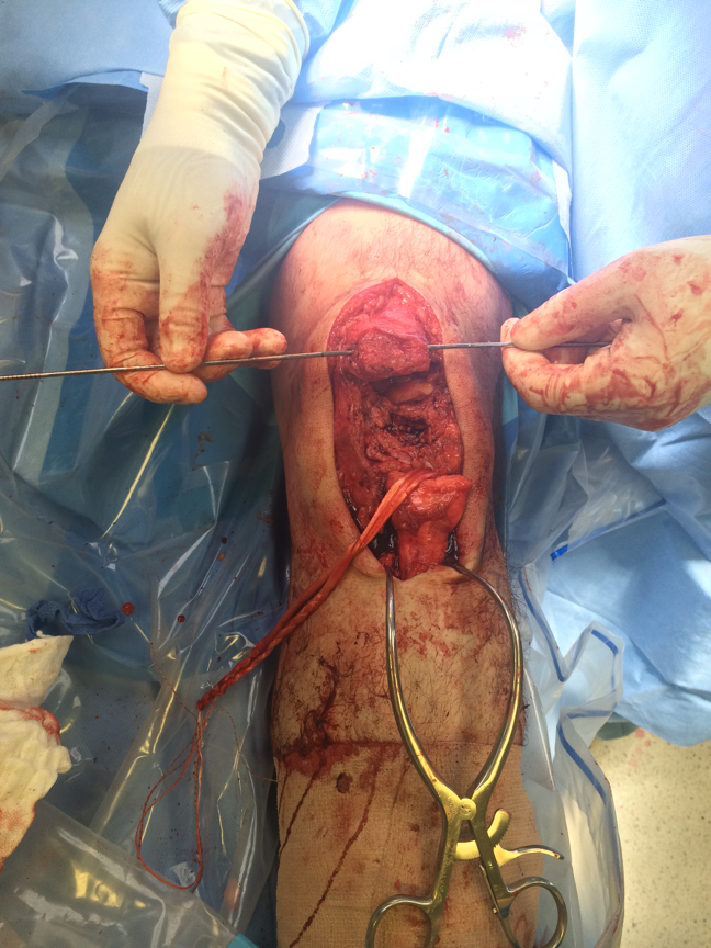 Chronic patella tendon rupture Hamstring Recon
