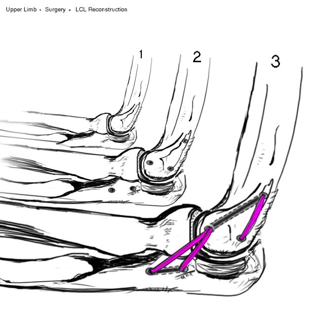 Lateral Ligament Elbow Reconstruction