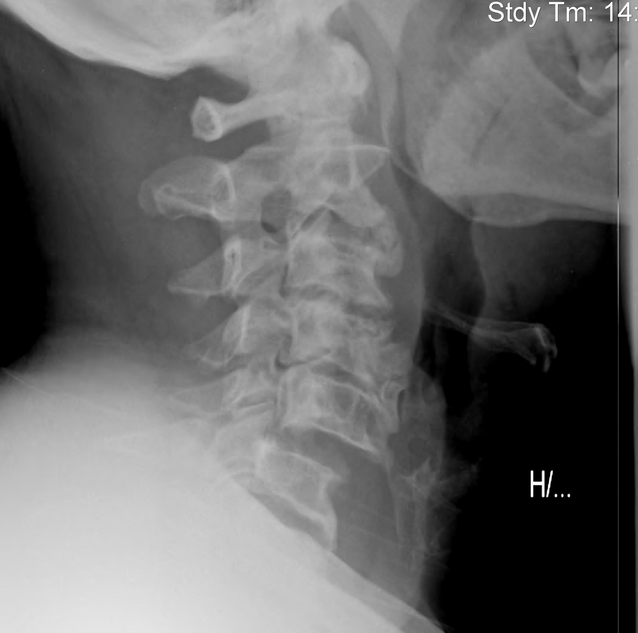 dislocated neck x ray