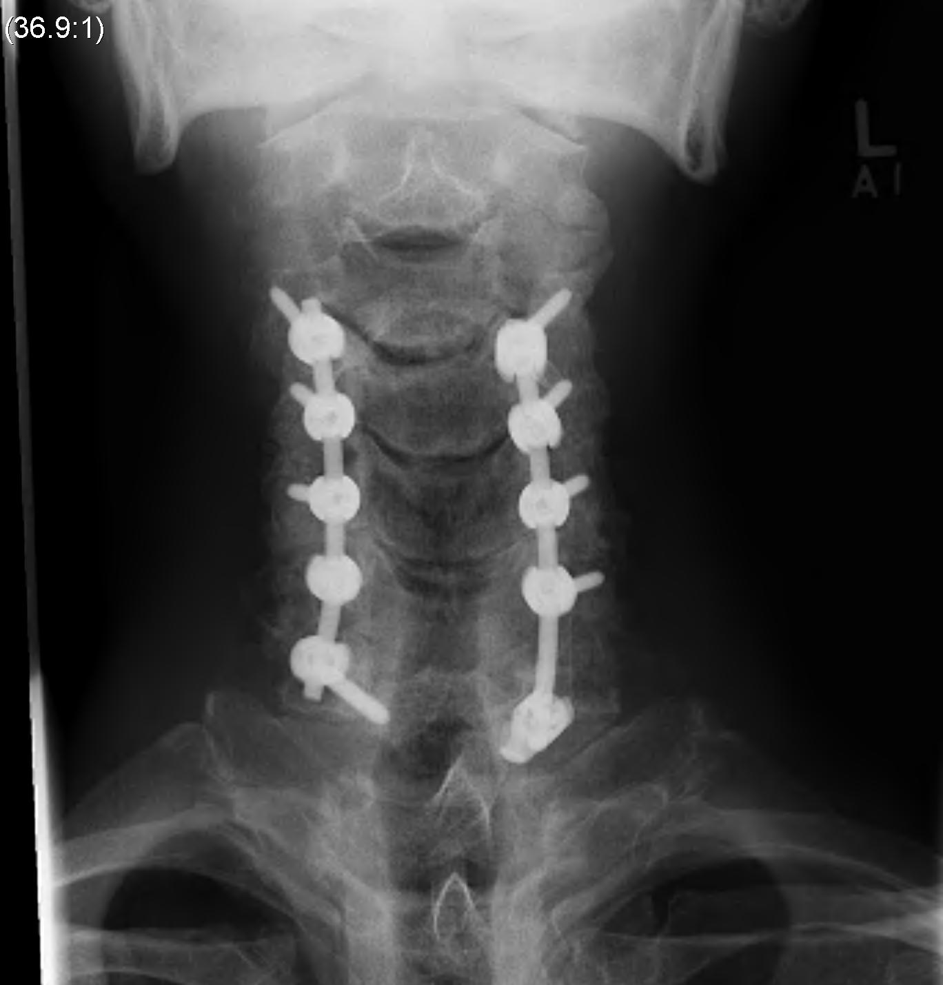 Cervical Kyphotic Deformity