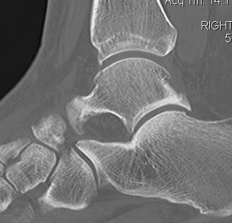 Ankle CT Anterior Osteophyte