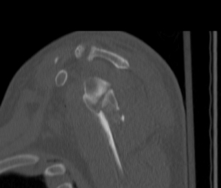Scapula Fracture Intra articular CT Sagittal