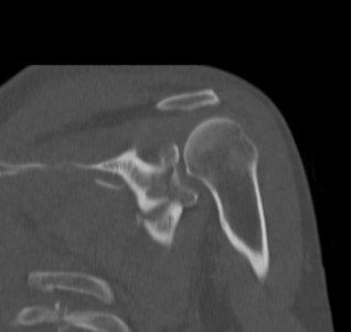 Scapula Fracture Intra articular Glenoid Coronal CT
