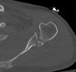 Scapular fracture intraarticular glenoid axial