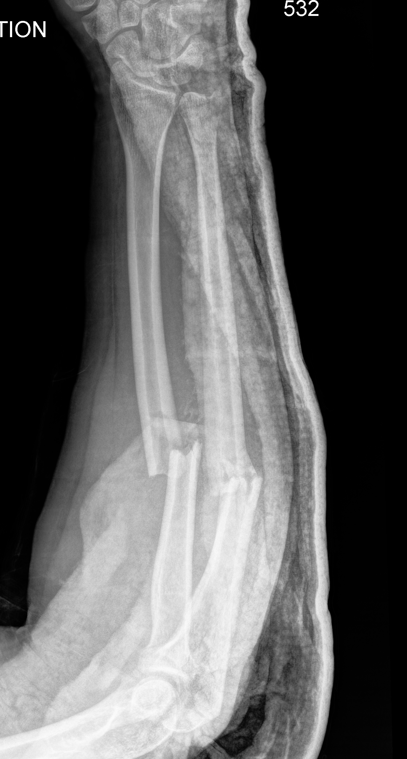 Bone bone forearm fracture AP