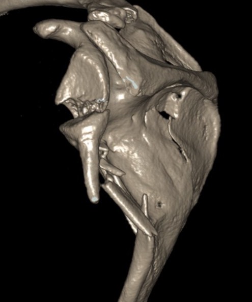 Combined scapula glenoid
