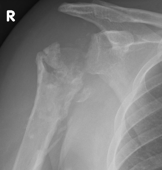 resection shoulder arthroplasty for infection
