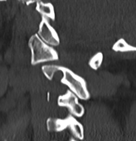 Atlanto-axial CT 1