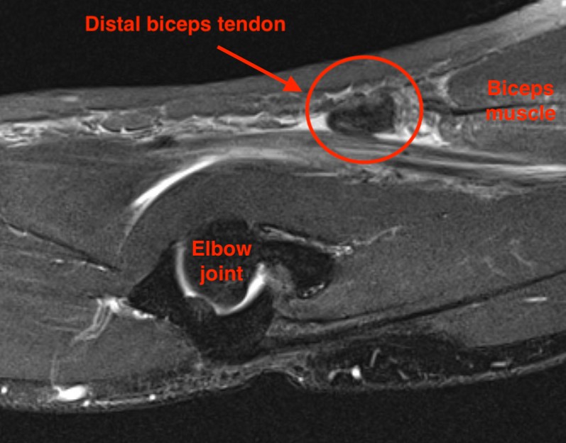 Distal biceps rupture MRI