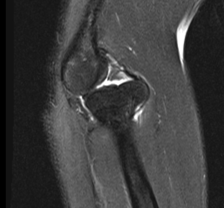 Missed Monteggia MRI