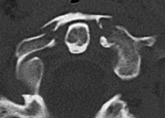 Atlas isolated anterior arch