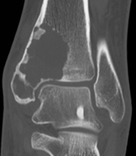 ABC CT ankle