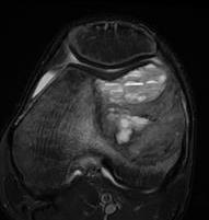 MRI ABC distal femur