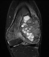 ABC distal femur MRI