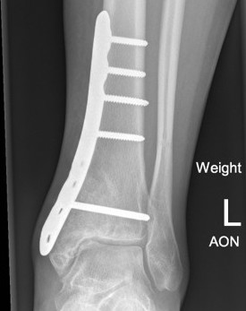 ABC ankle bone graft ORIF