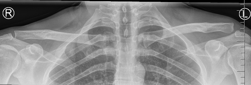 Type II AC joint dislocation