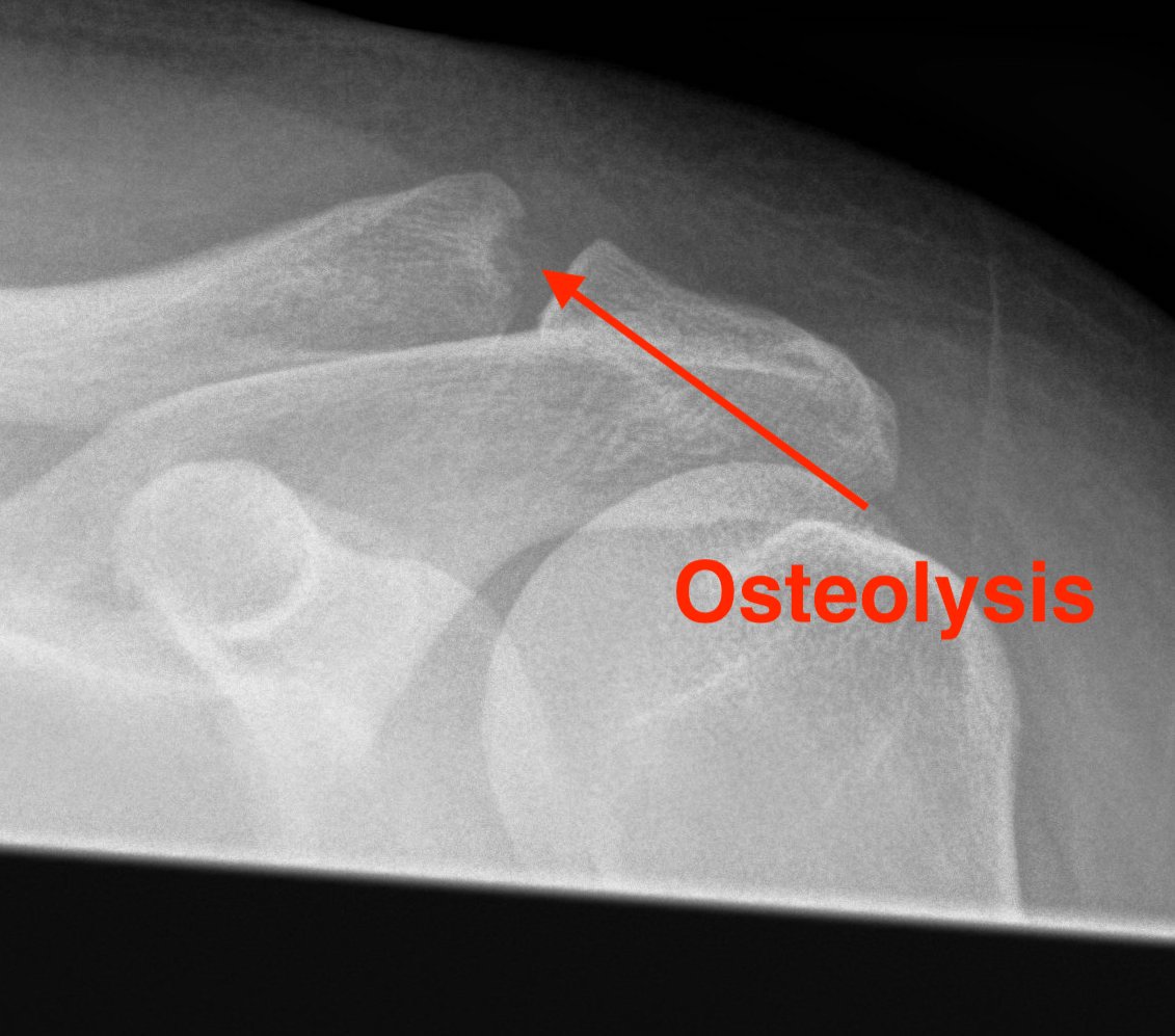 ACJ osteolysis
