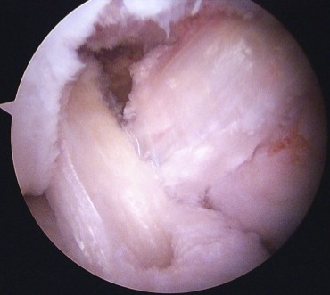 ACL PCL recon