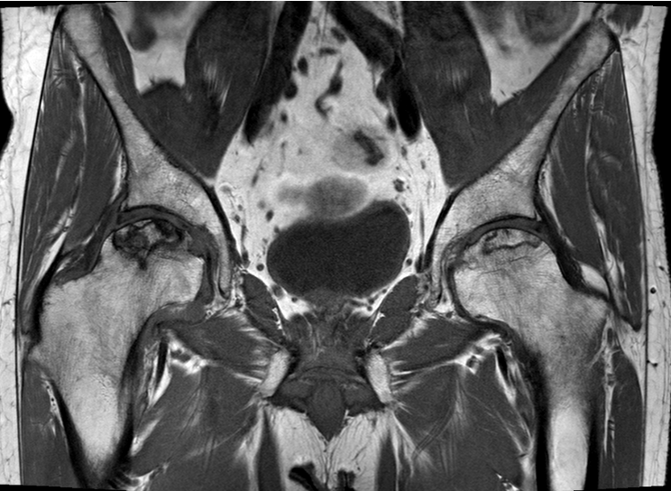 Hip AVN MRI