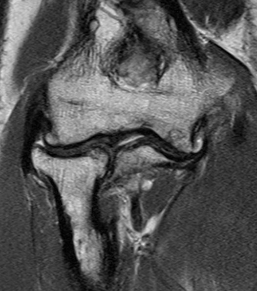 MRI elbow OA