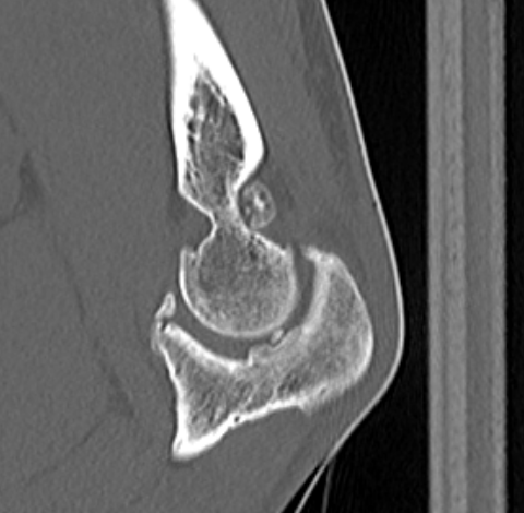 Elbow OA sagittal CT