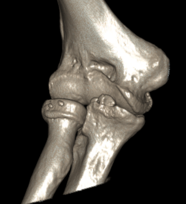 3D CT elbow OA 1