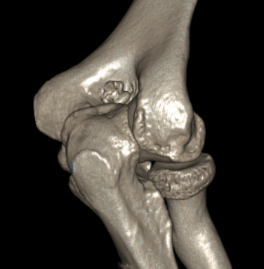 3D elbow CT OA 2