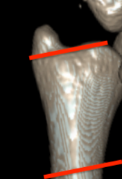 ulna styloid