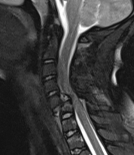 Bilateral facet joint MRI