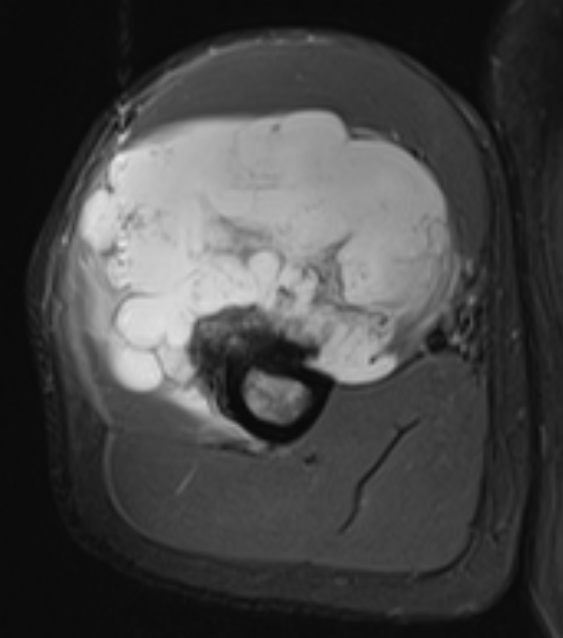 CS humerus MRI 2