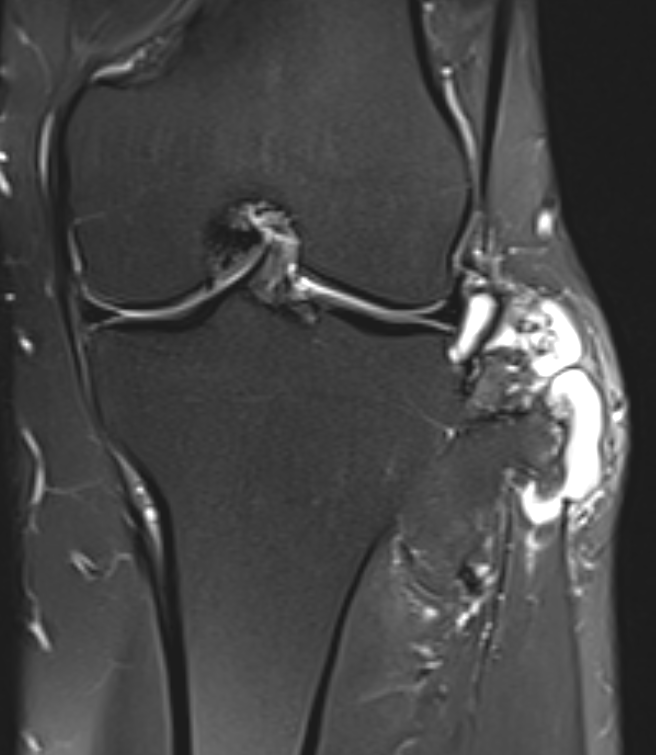 CS knee MRI 1