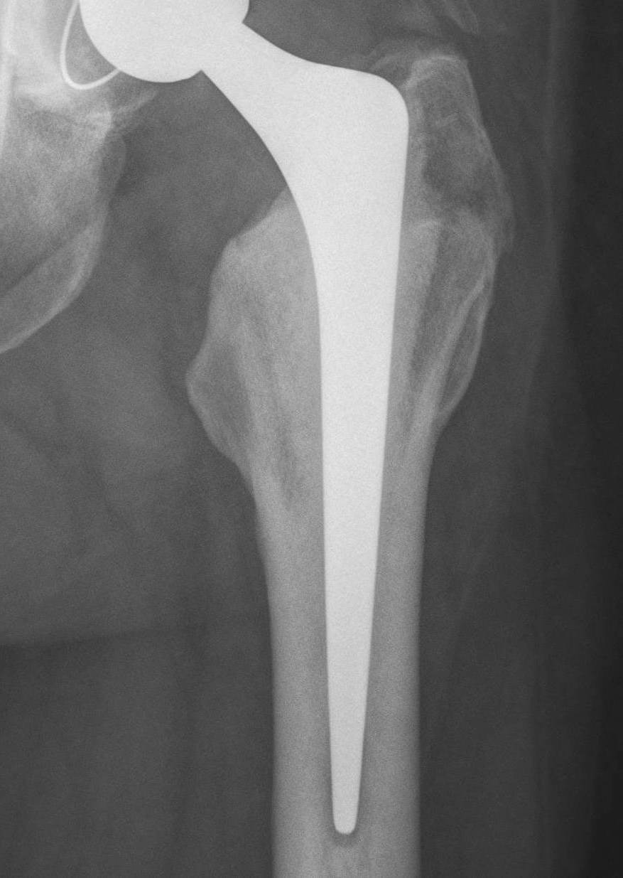 Cemented femur