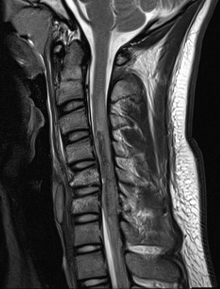 Spinal cord injury MRI