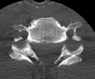 Bilateral facet dislocation CT