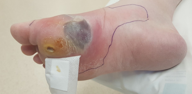 Diabetic ulcer