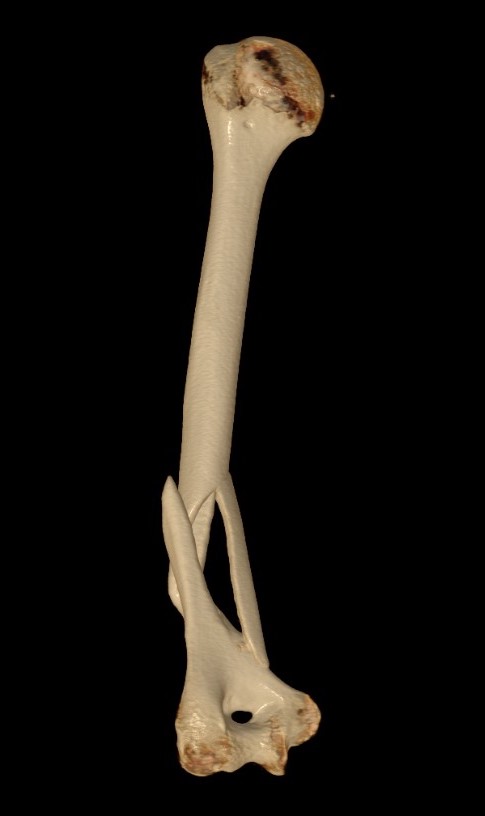 Distal humerus
