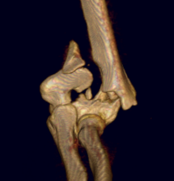 CT distal humerus fracture