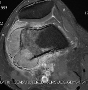 Ewings femur MRI axial